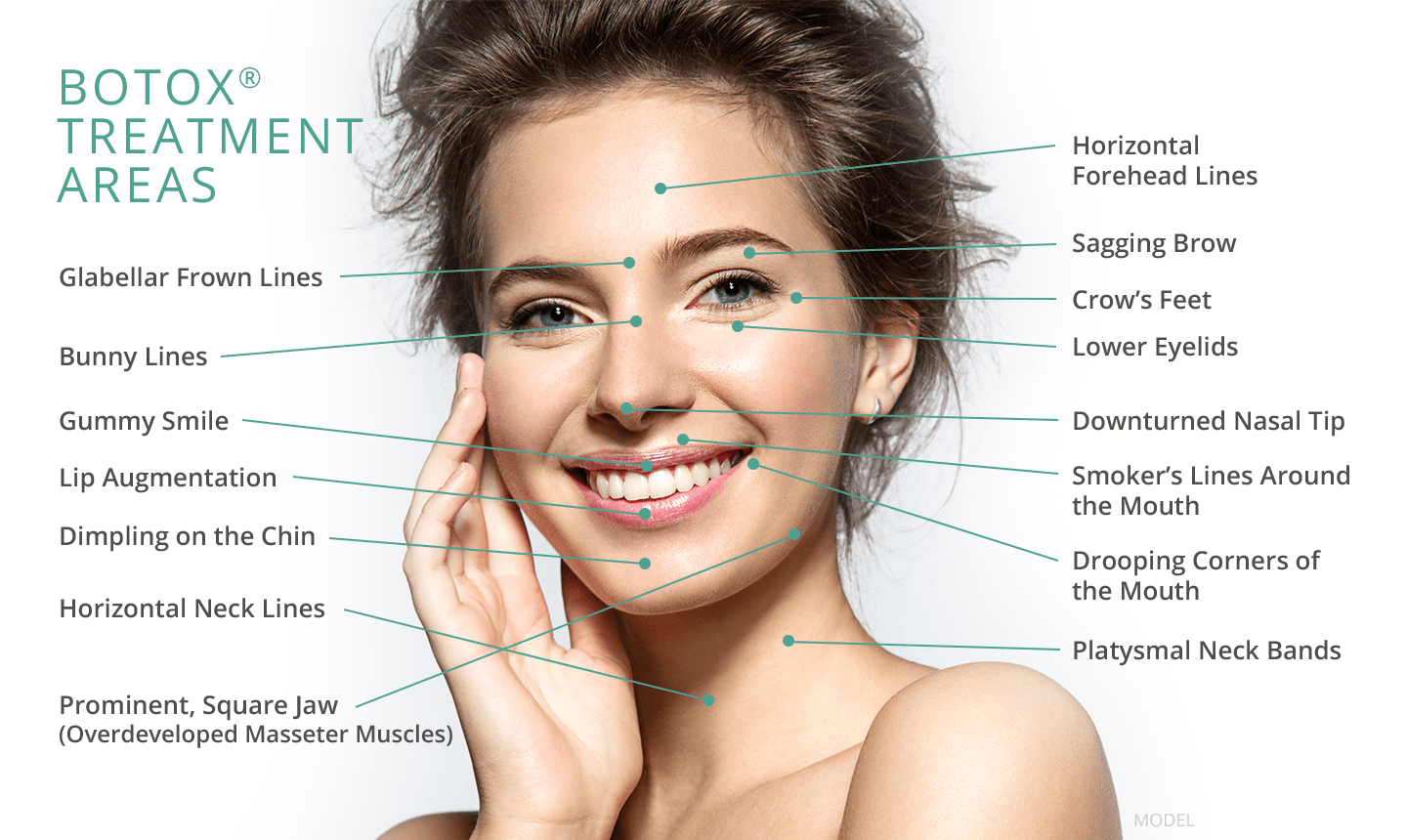 Botulinum Toxin