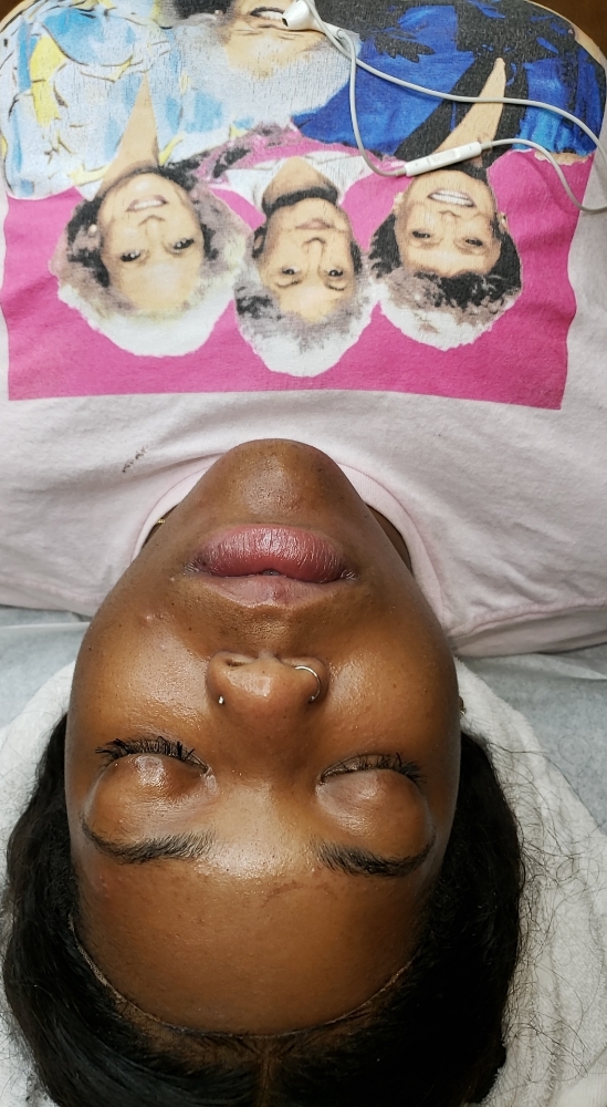 Chemical Peel