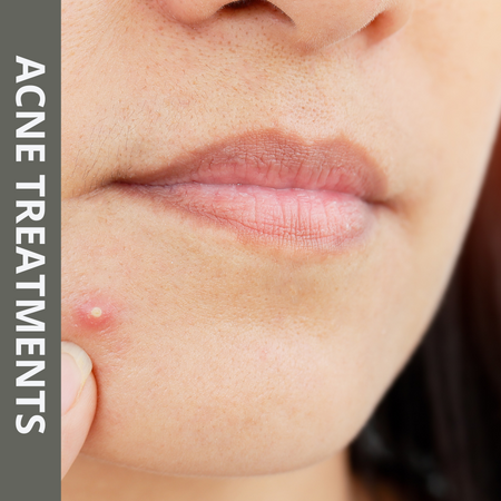 First Time Clinical Acne Treatment