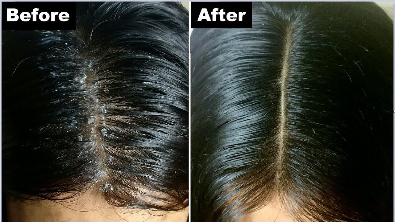 Dandruff Shampoo Treatment