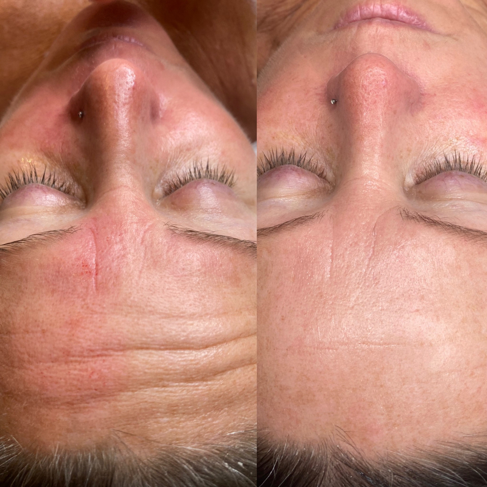 Microneedling