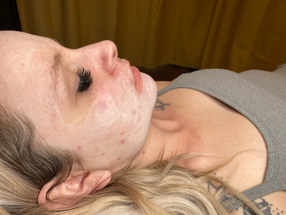 Chemical Peels