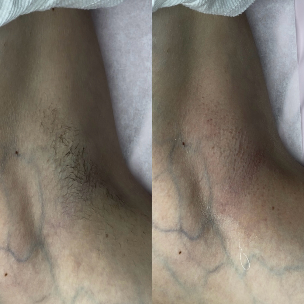 Underarm Wax