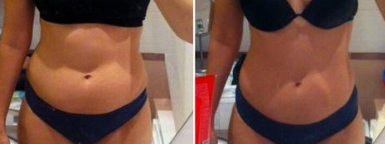 Ultrasonic Cavitation/Lipo