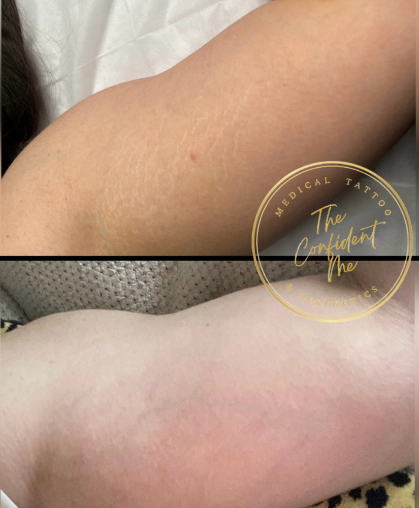 Scar & Stretch Mark Treatment