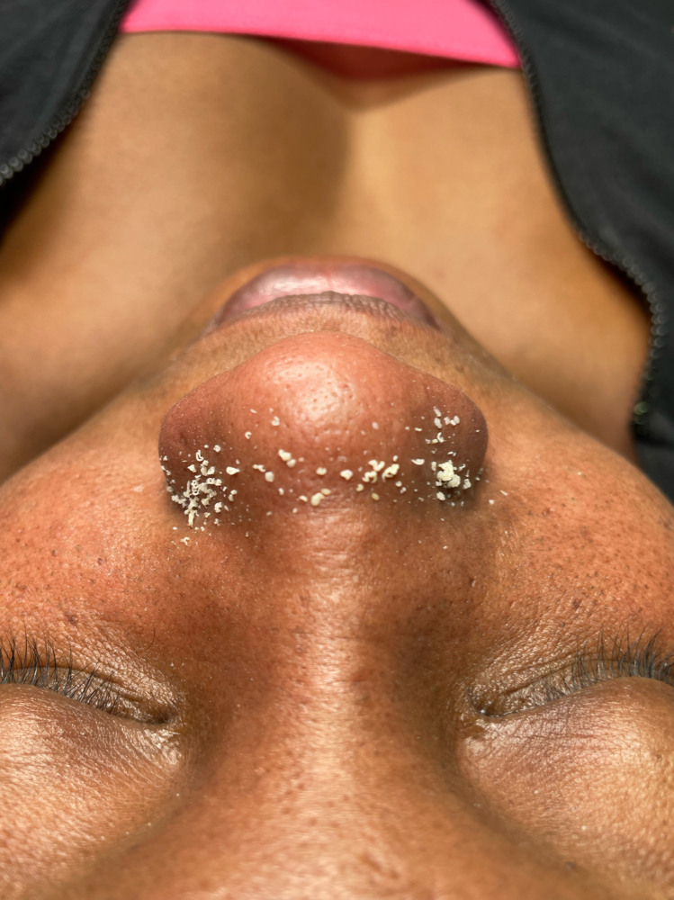 Extractions