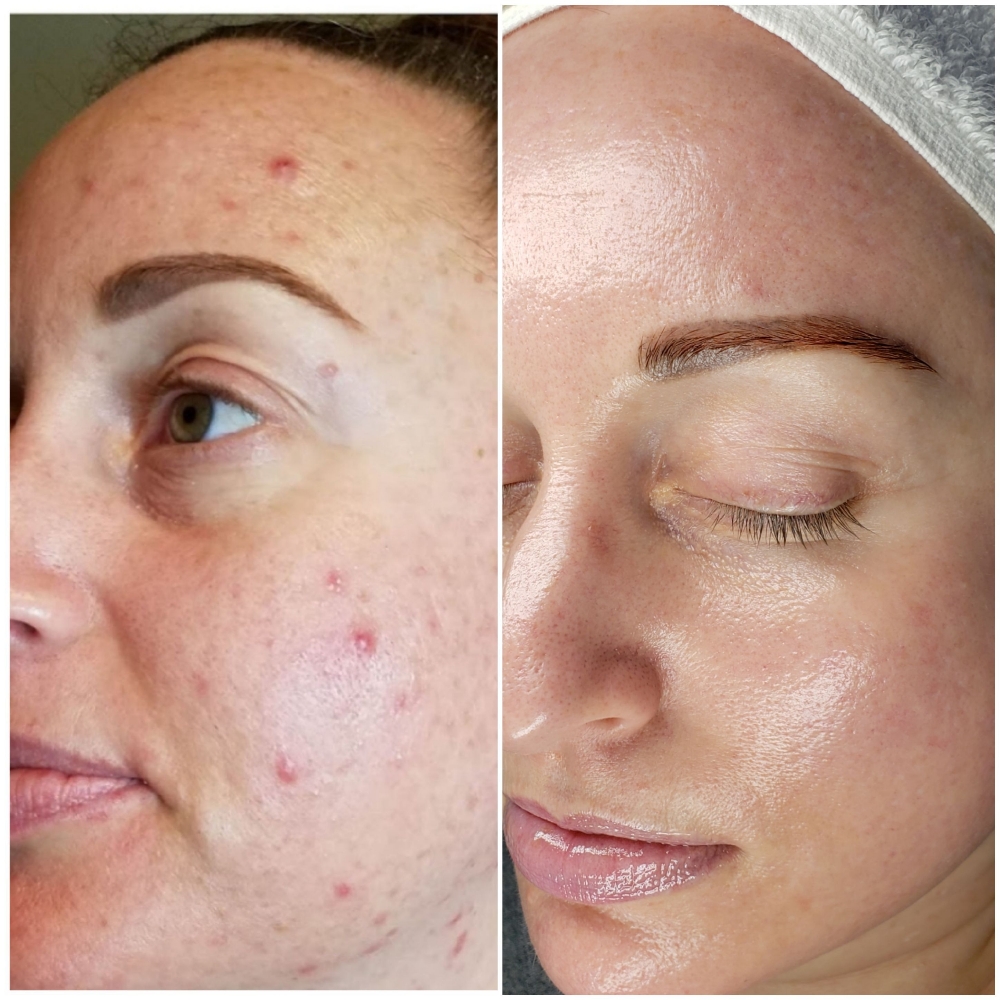 Mineral Microneedling