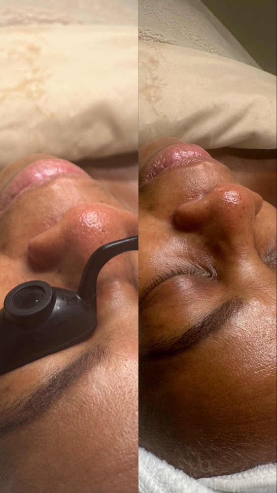 Oxygen Peel Facial at J Esthetics in Homewood, IL