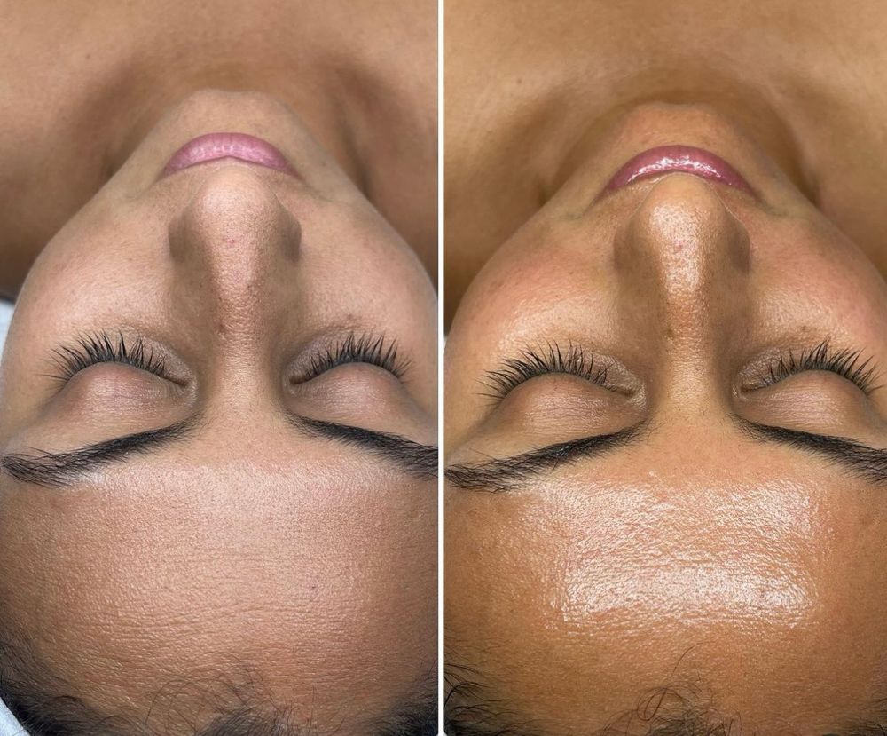 BioRepeel Chemical Peel at Serene.Esthetics in Franklin Square, NY