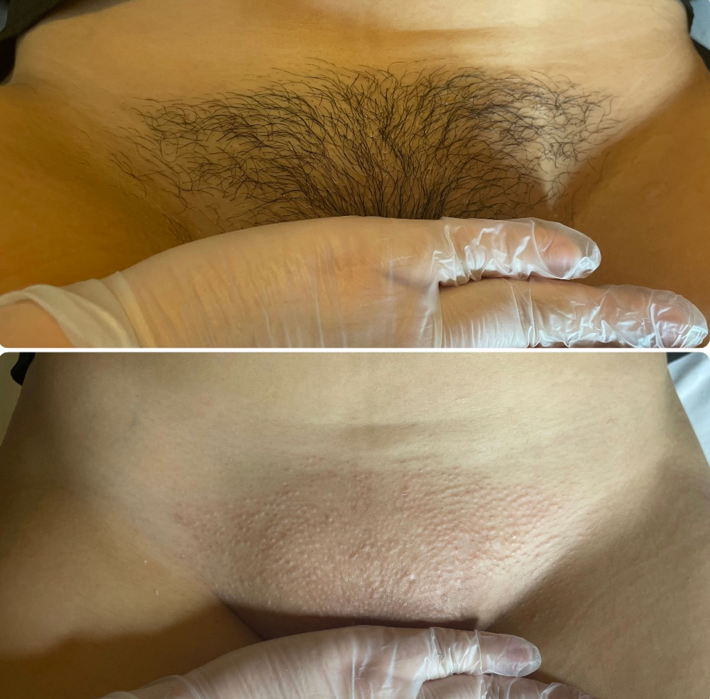 Brazilian Wax