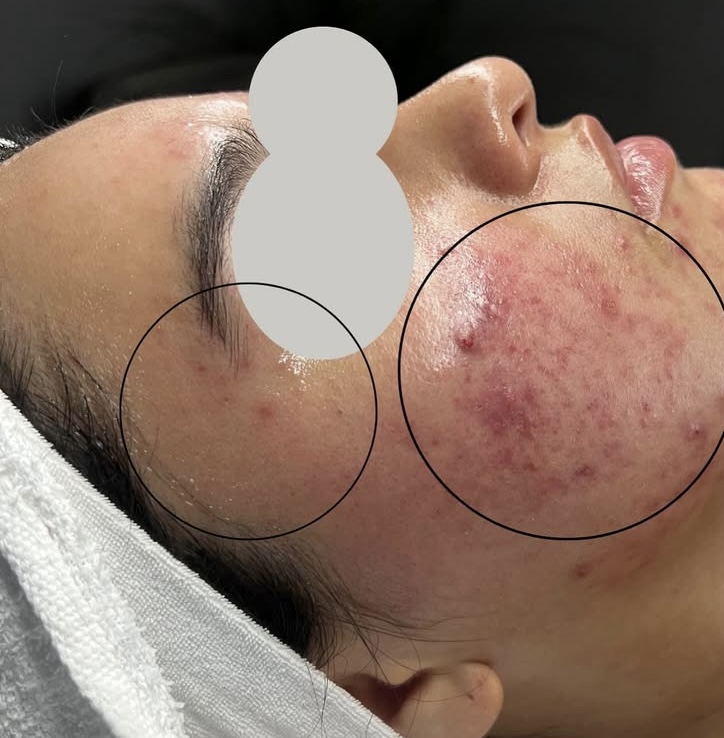 Acne Facial