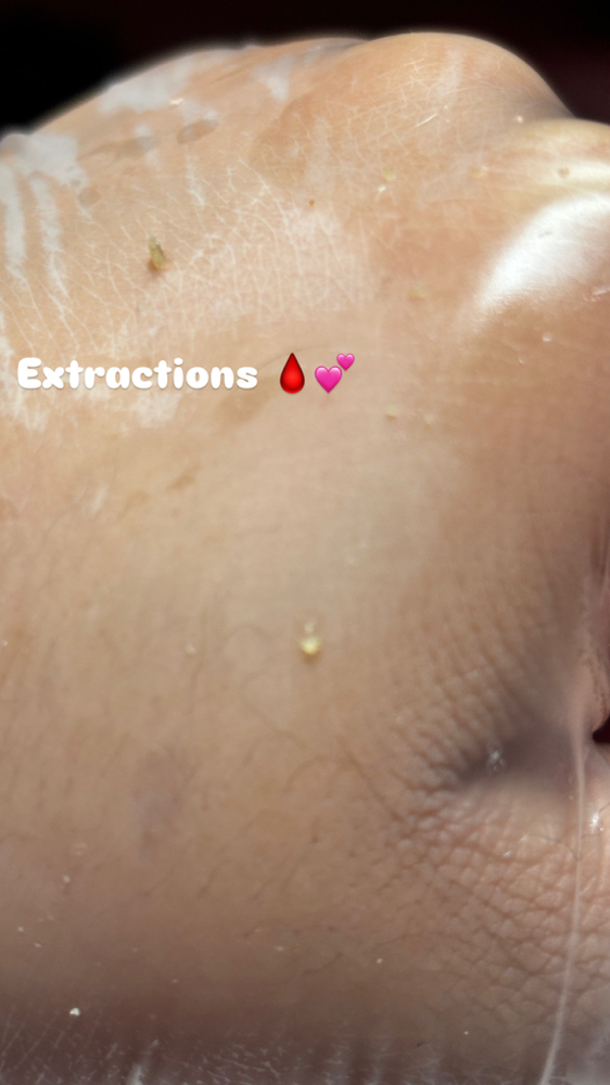 Extractions