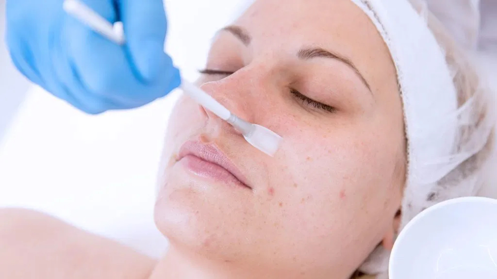 Pigment Or Retinol Chemical Peel