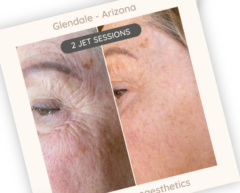 Pro Plasma Series Of 3 Treatments