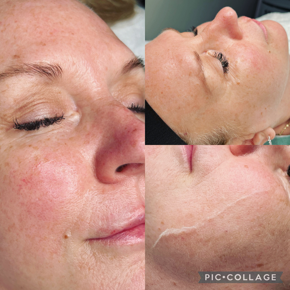 Dermaplane Facial