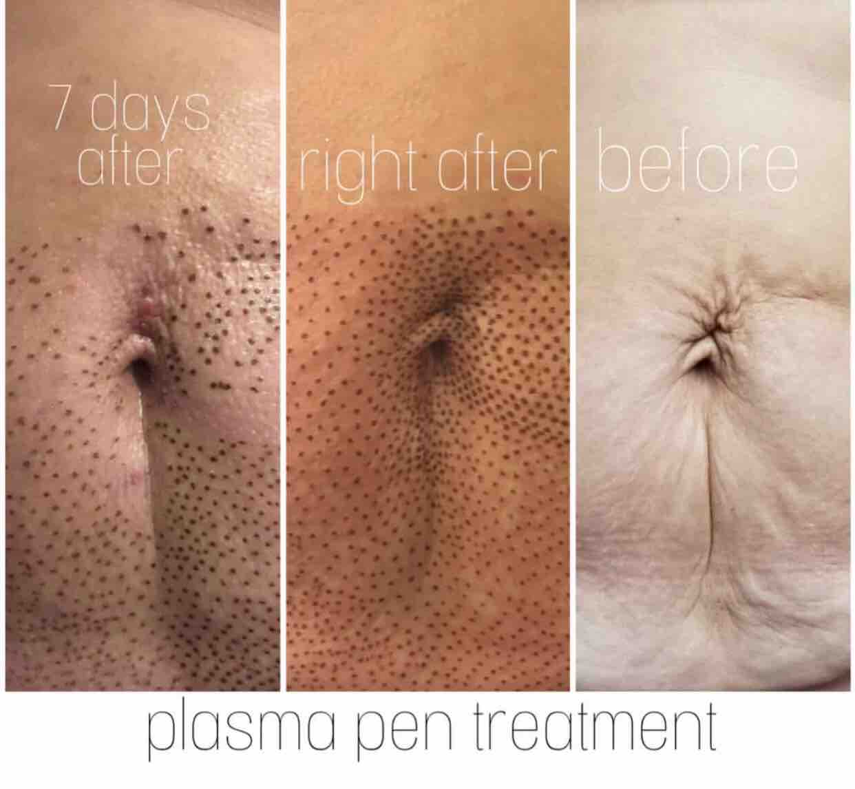 Strechmark Removal Plasma