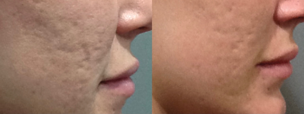 MicroNeedling Facial