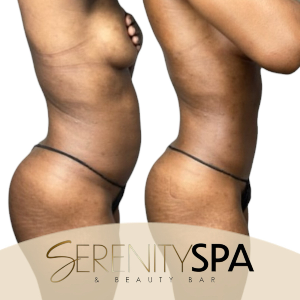 Lipo 360 Combo at Serenity Spa & Beauty Bar in Warwick, RI