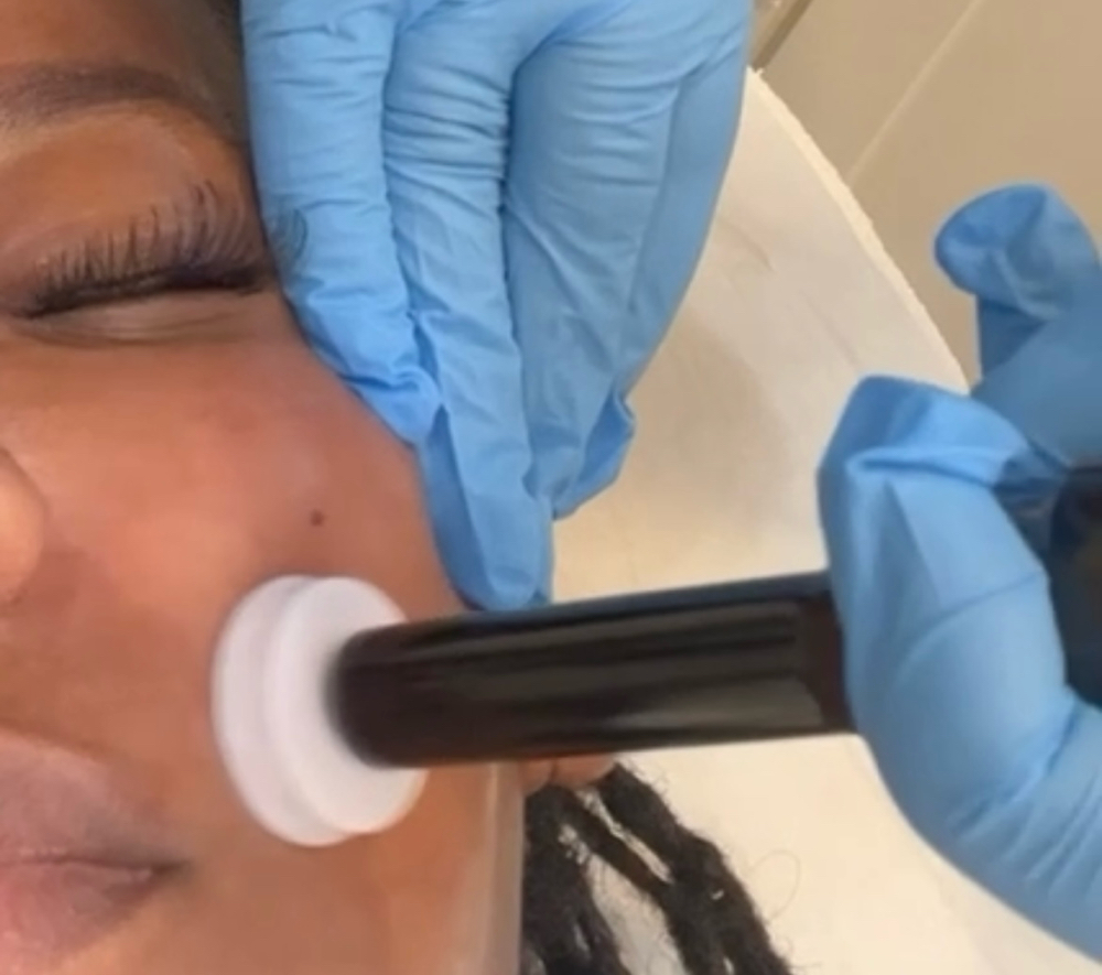 Stem cell Skin Renewal