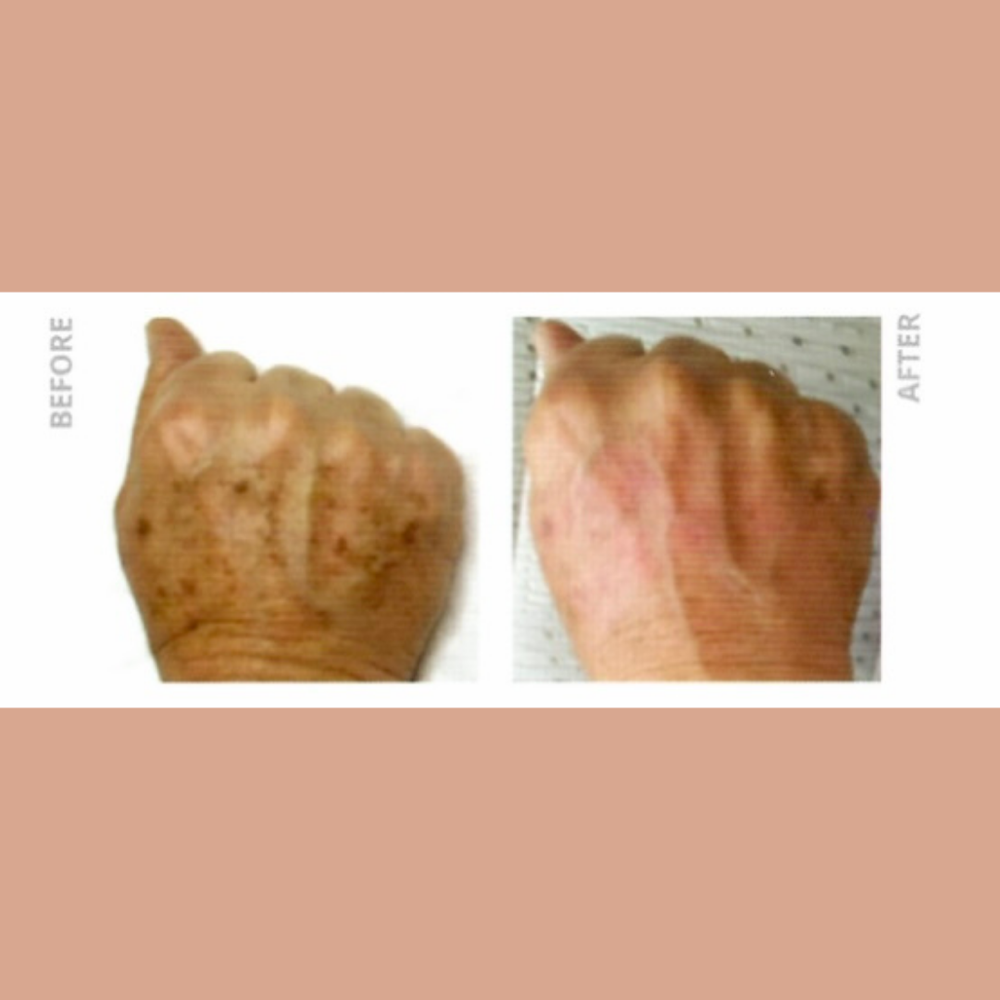 Pigmentation Reduction