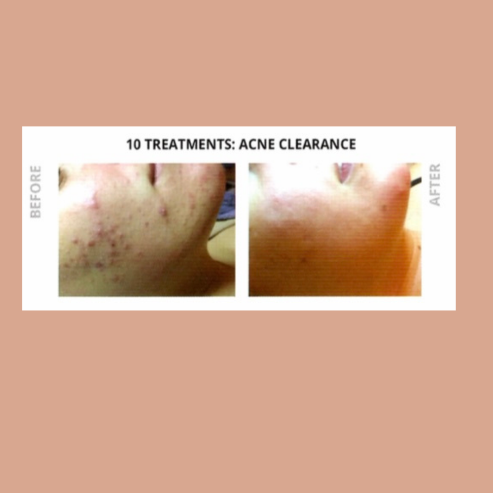 Acne Clearance Treatment