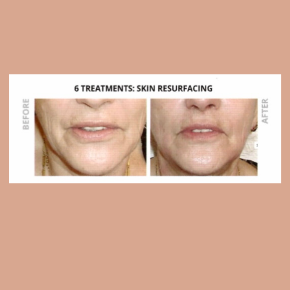 Laser Resurfacing- Face