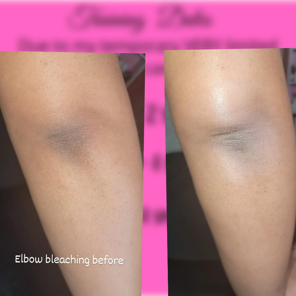 Elbow Skin Correction