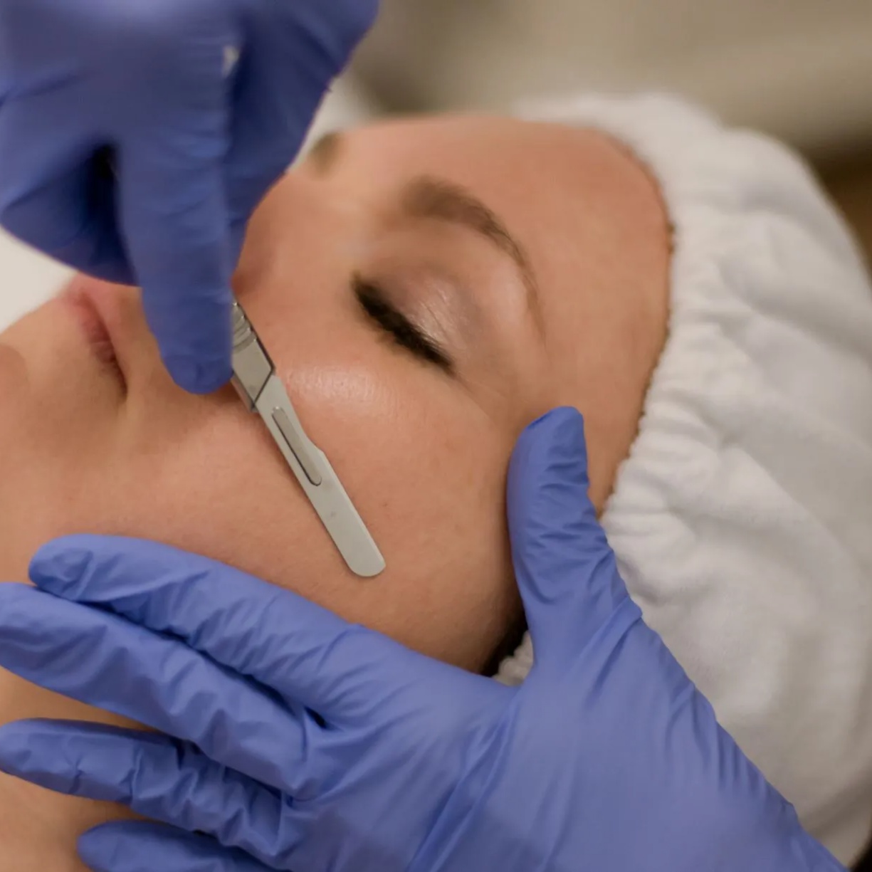 Dermaplaning at Muy Bueno Injections by Pat MSN RN in San Antonio, TX