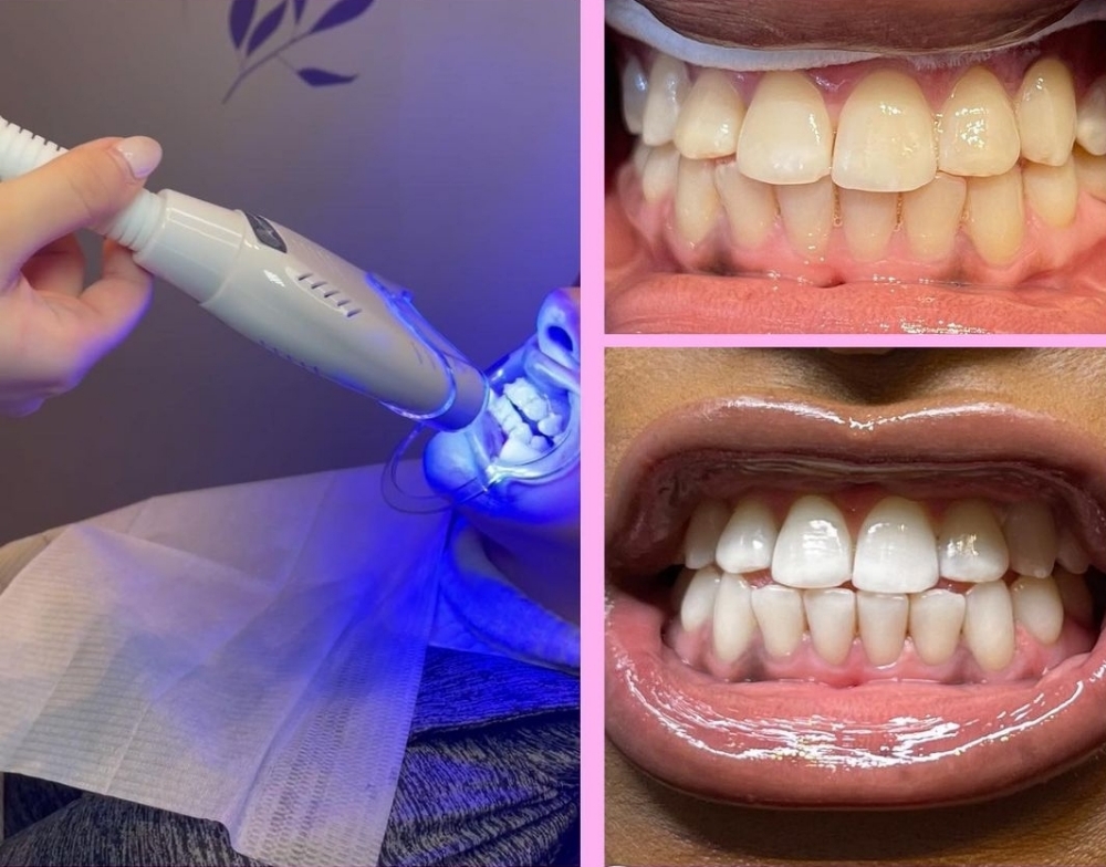 Foot Detox / Teeth Whitening Combo