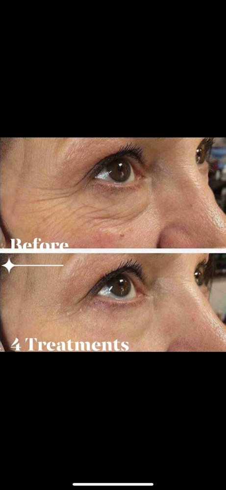 Microchanneling SALE 4 Treatments