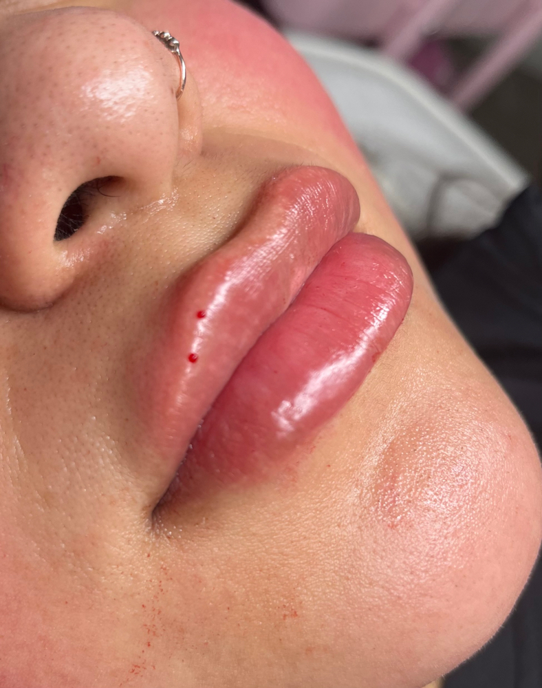 Micro-needle Lips