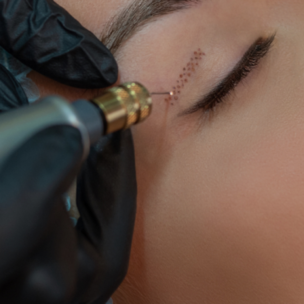 Fibroblast Plasma Treatment at ONYX Laser Skin Therapy in Anthem, AZ