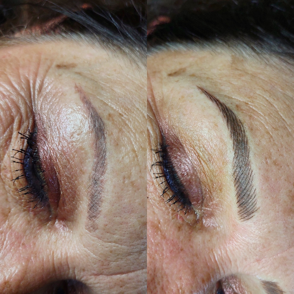 Brow Correction