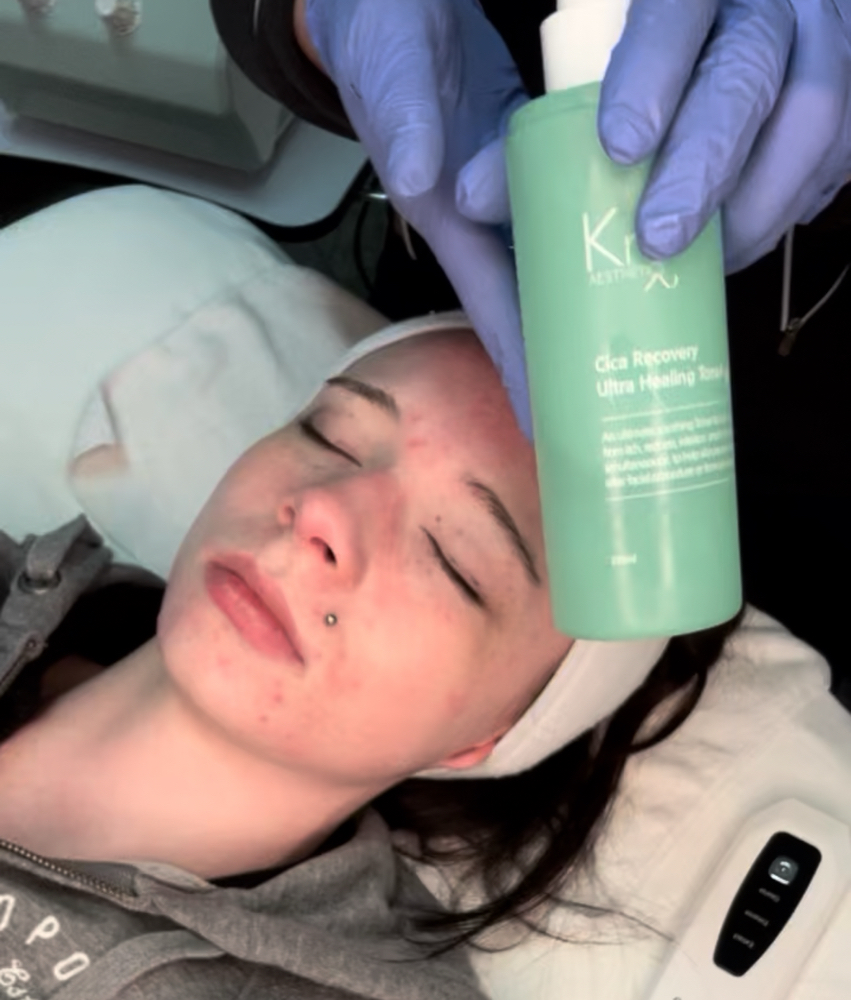 Mother’s Day Hydrafacial