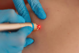 Skin Tag Removal