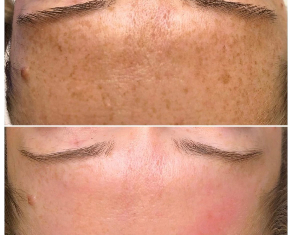 Microderm Facial