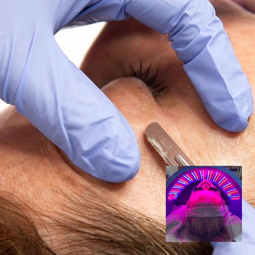 Dermaplaning  w/ LED Light  CELLUMA