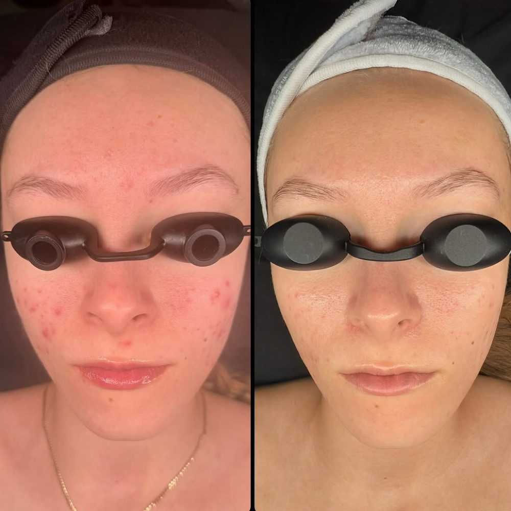 Clear Skin Method - Consult at Clarity Skin in Cherry Valley, IL