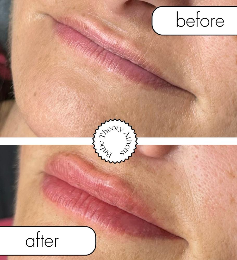 Full Syringe Lip Filler INTRO PRICE