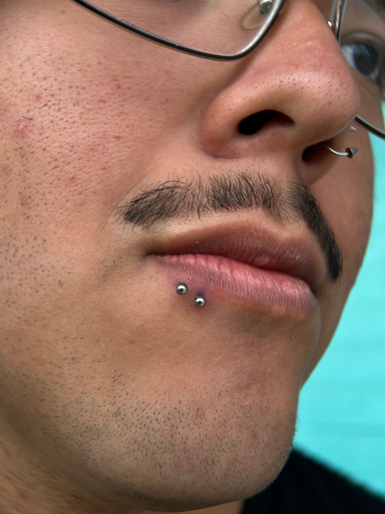 Snake bites , spider bites etc