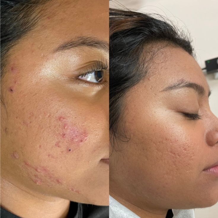 Acne Peel and Perfect Facial