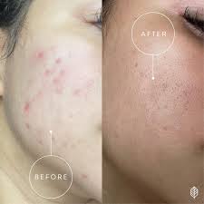 Hyperpigment Brightening Facial