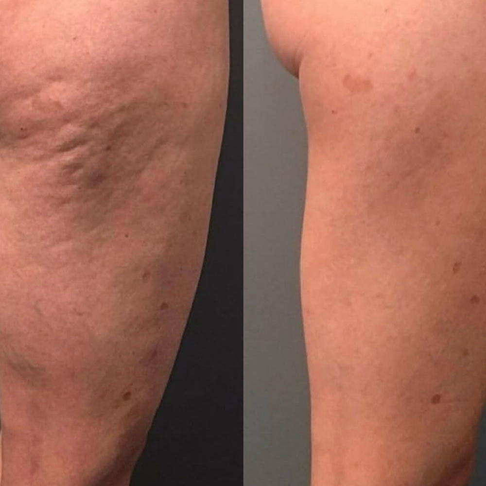 Celluclear at Sculpting Beauty by Pam LLC in Atascocita, TX