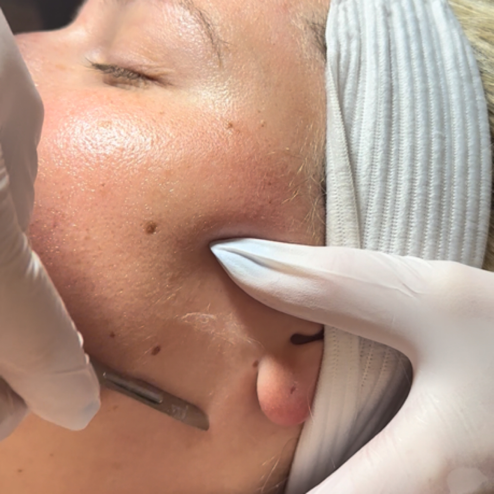 Dermaplane Treatment at Rylee Ann Esthetics in Woodstock, GA