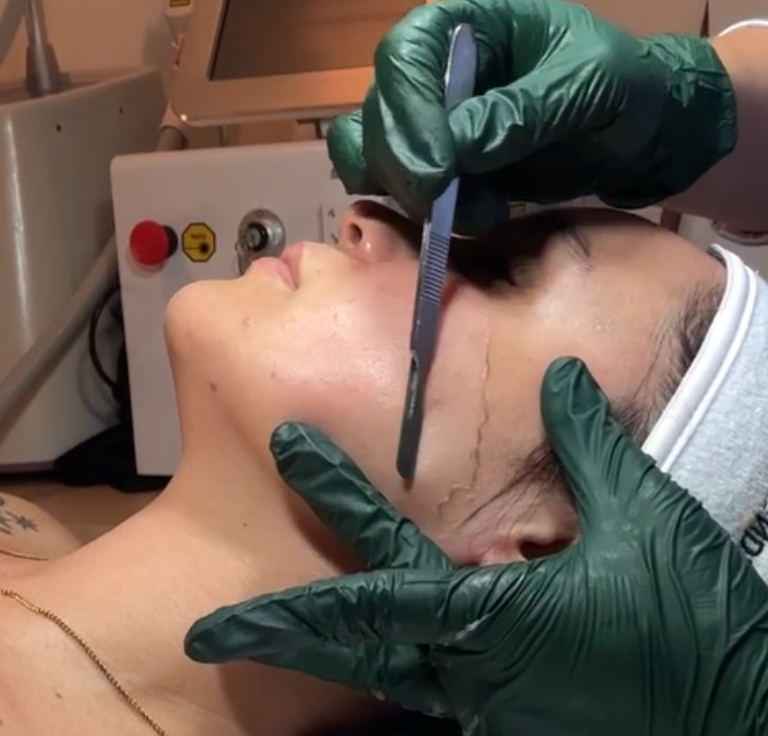 Dermaplane Querido