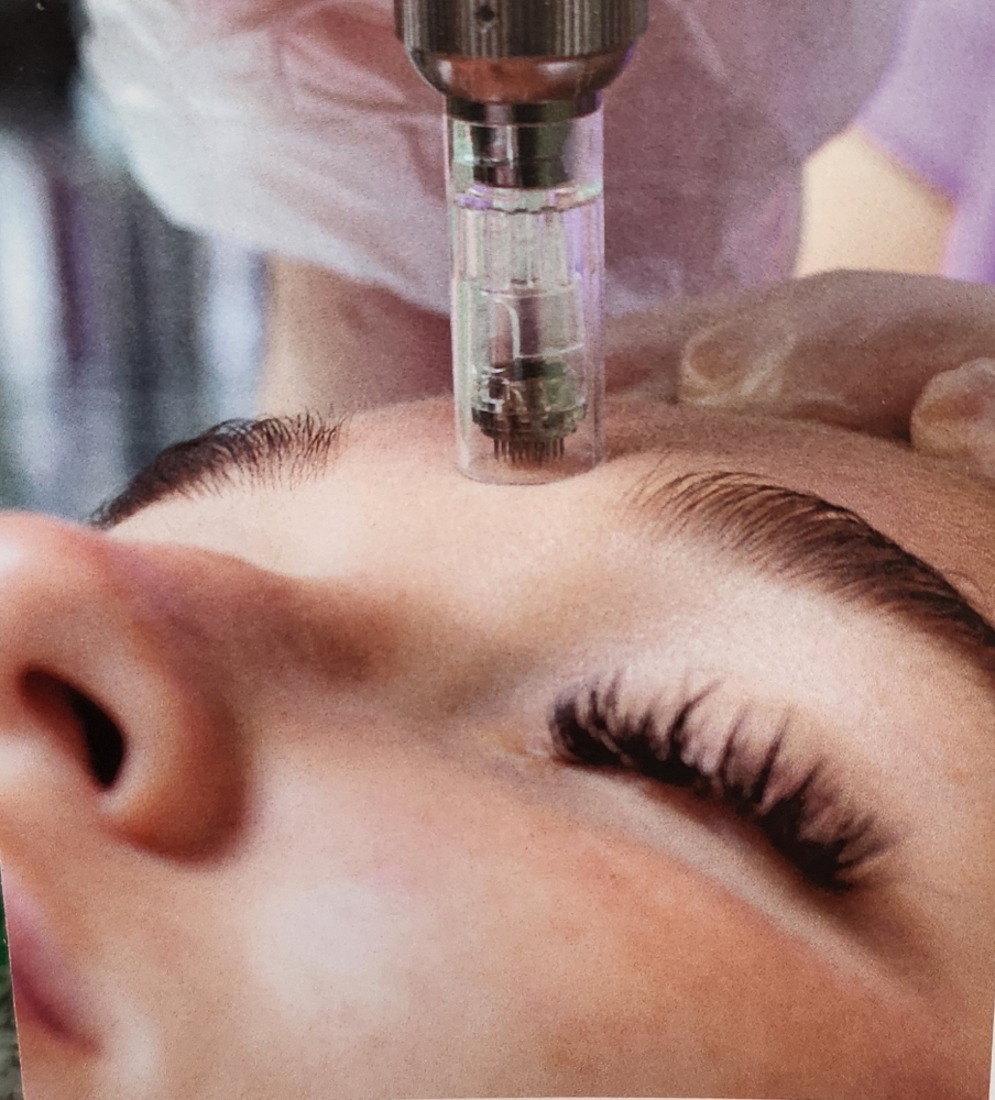 Microneedling (Collagen Induction)