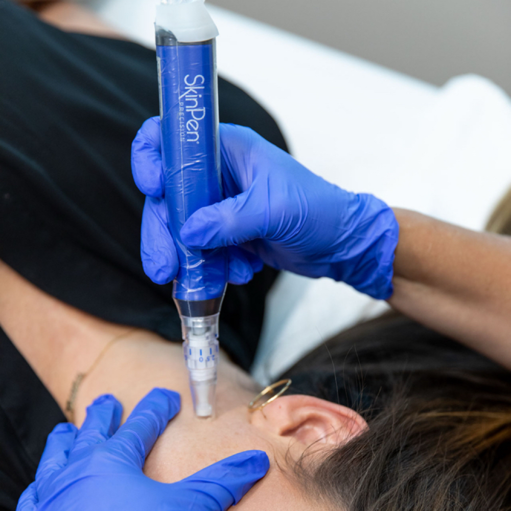 Skinpen Microneedling Face Only at Anfissa Beauty in Mount Angel, OR