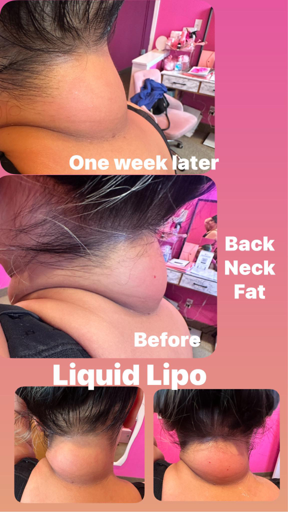 Liquid lipo  (Lipo Shots)