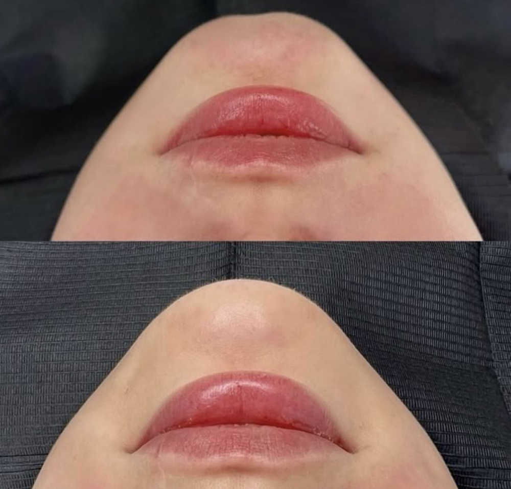 Balance Me: Chin Filler
