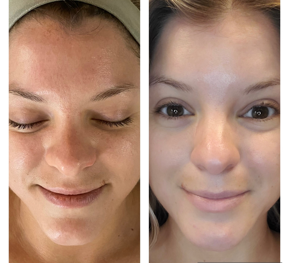 Microneedle Facial